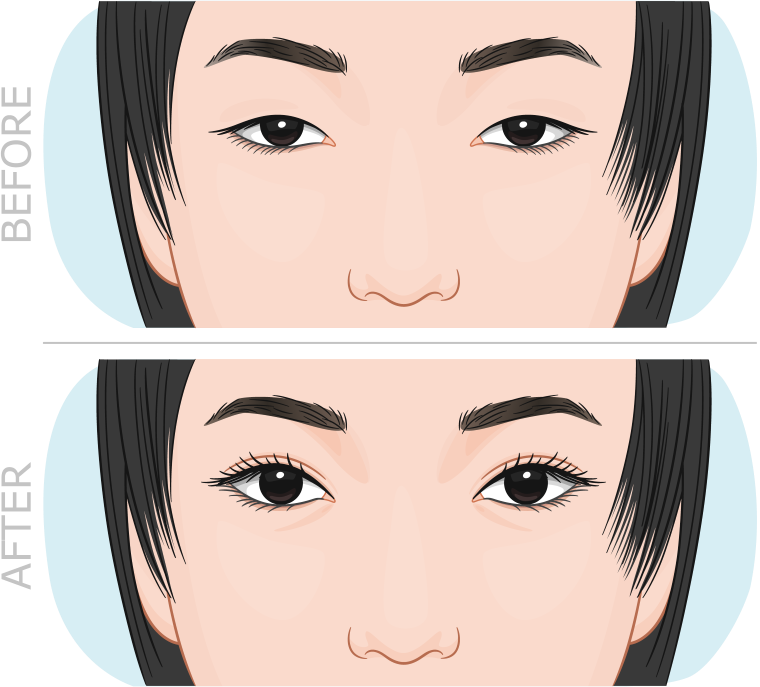 Asian Blepharoplasty