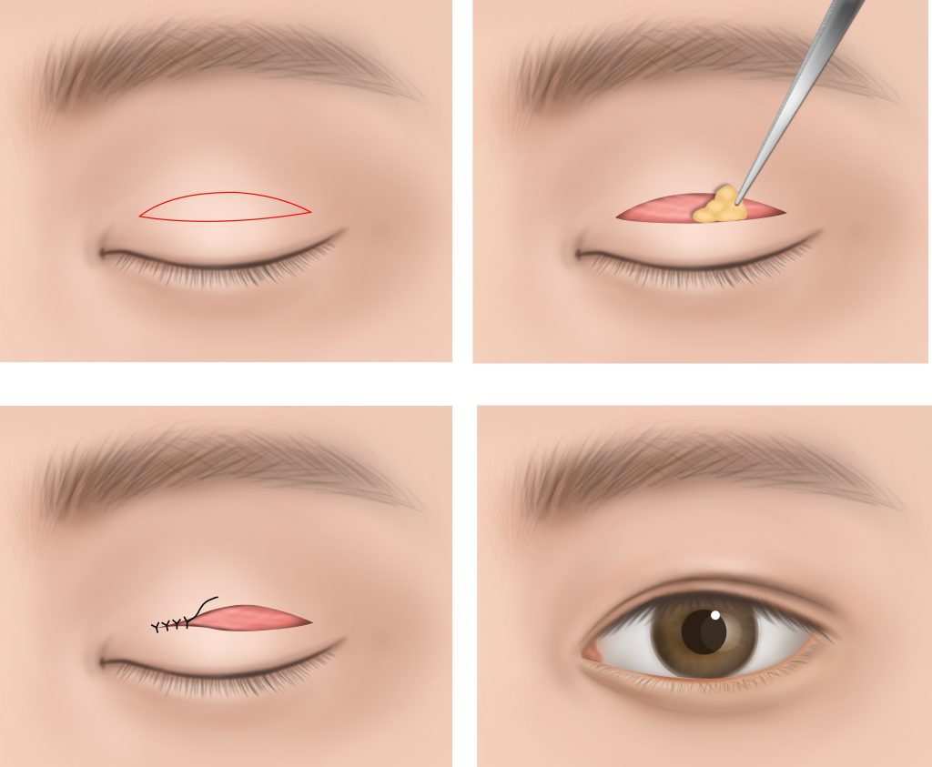 Blepharoplasty (1)