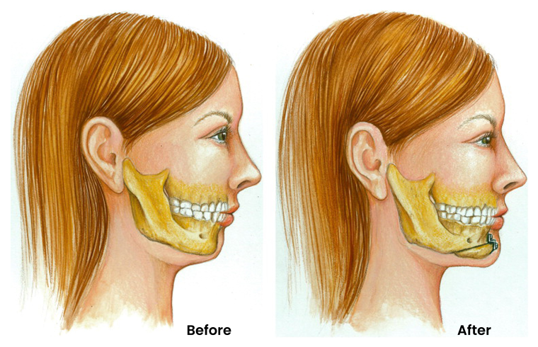 Facial Implants and Contouring2 (1)