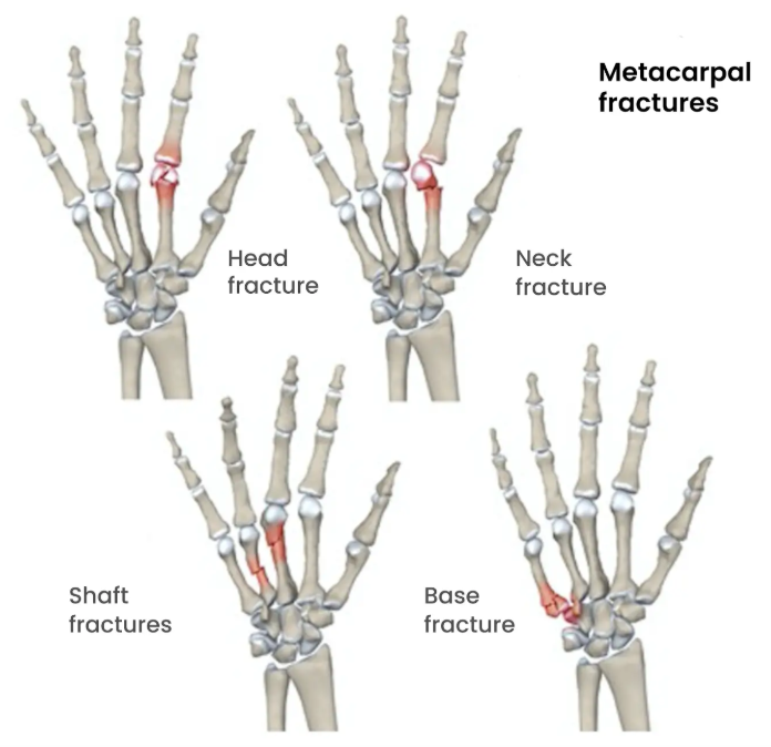 Hand Injuries Types Reconstructive Surgery Perth | Skin, Trauma & Hand